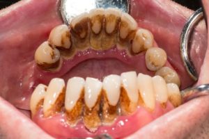 Симптомы болезни - боли в зубах