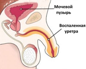 Симптомы болезни - боли в уретре