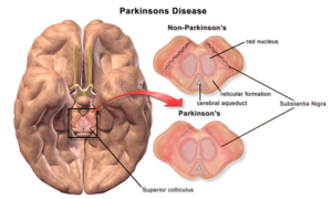 Болезнь Паркинсона: Путешествия