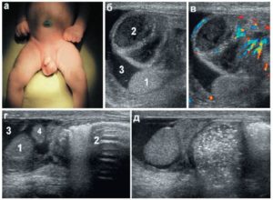 почему у мальчика после сна яички уходят внутрь?