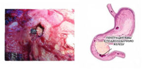 Пенетрация язвы желудка и двенадцатиперстной кишки