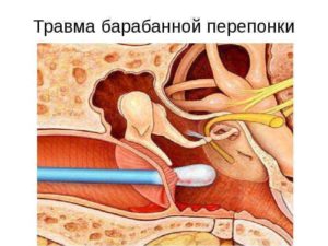 Повреждения барабанной перепонки