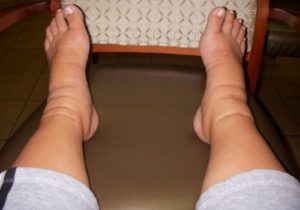 Отёки ног после операции