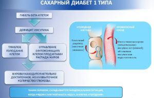 Сахарный диабет 1 типа: Лечение дома