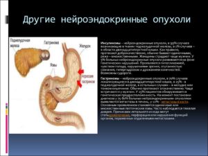 Нейроэндокринные опухоли поджелудочной железы