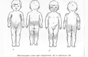 Как определить болел ли ребенок краснухой?