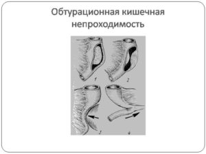 Обтурационная непроходимость кишечника