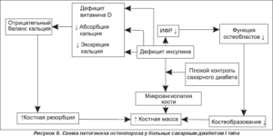 Диабет 1 типа остеопороз