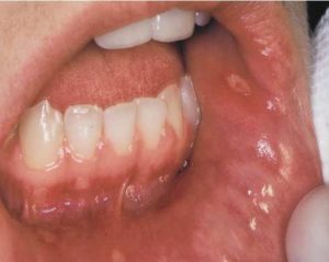 Здоровье полости рта: Стоматит