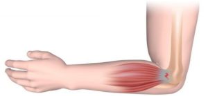 Эпикондилит локтевого сустава