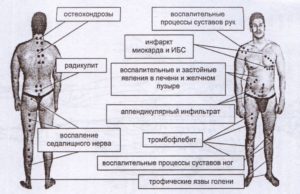 Примерные схемы лечения пчелоужалением