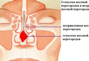 Гематомы и абсцессы перегородки носа