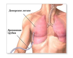 Дренажная трубка в лёгких