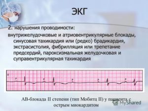 Симптомы болезни - нарушения желудочковой проводимости