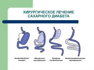 Сахарный диабет 2 типа: Хирургическое лечение