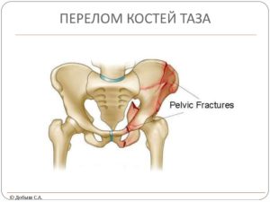 Повреждения костей таза