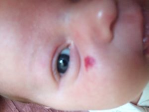 У ребёнка белое пятно на щеке и закисают глаза.