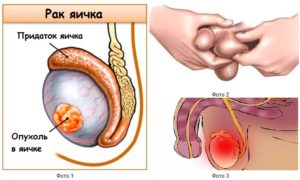 уменьшилось яичко, что делать?