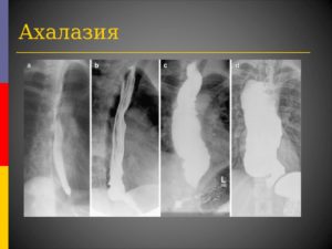 Ахалазия кардии (кардиоспазм) пищевода