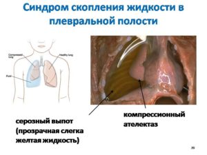 жидкость скапливается в плевральной области