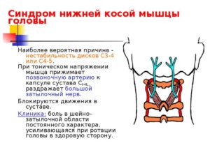 Осложнения остеохондроза – головная боль и синдром нижней косой мышцы головы