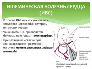 Ишемическая (коронарная) болезнь сердца