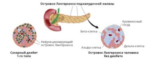 Трансплантация островковых клеток в качестве одного из способов лечения сахарного диабета