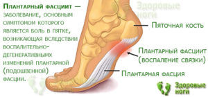 Пяточная шпора, плантарныи фасциит