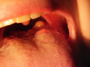 Неприятные ощцщения в области корня языка и горла слева