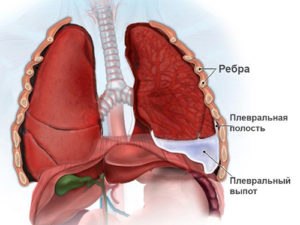 Острая эмпиема плевры