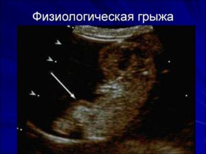 физиологическая эмбриональная кишечная грыжа