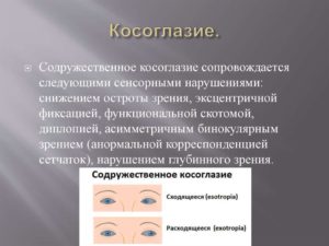 Содружественное косоглазие (Strabismus concomitans, Heterotropia)