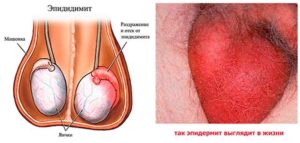 появился бугорок на яичке после лечения эпидидимита