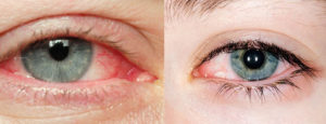 Как предотвратить синдром сухого глаза?
