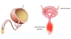 Цистоуретрит