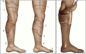 Ампутация нижних конечностей