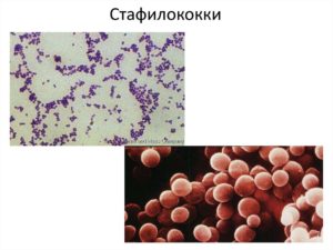 Стафилококк золотистый, стрептококк и клебсиелла пневмония