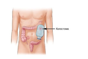 Существуют ли имплантанты толстой кишки