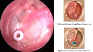образование грануляций  в ухе после острого гнойного отита