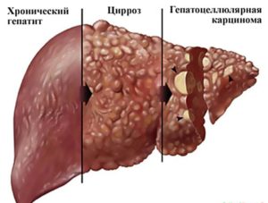 Гепатит С и рак печени