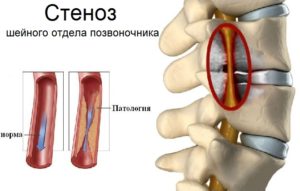 Стеноз спинномозгового канала