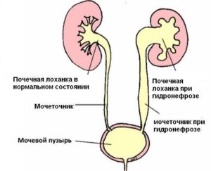 гидрокаликоз при беременности