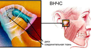 Дисфункция височно-нижнечелюстного сустава