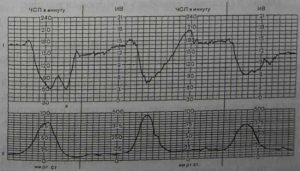 Интранатальная кардиотокография