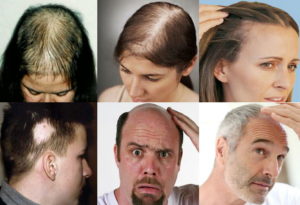 Мужчины и Потеря волос: Каковы Варианты?
