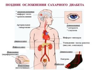 Сахарный диабет 1 типа: Жизнь с осложнениями