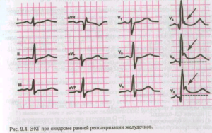 Симптомы болезни - нарушенияпроцессов реполяризации желудочков