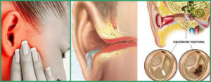 образование грануляций  в ухе после острого гнойного отита