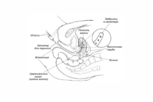 Тонус матки после переноса эмбрионов