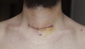 После операции на щитовидке  не восстанавливается голос